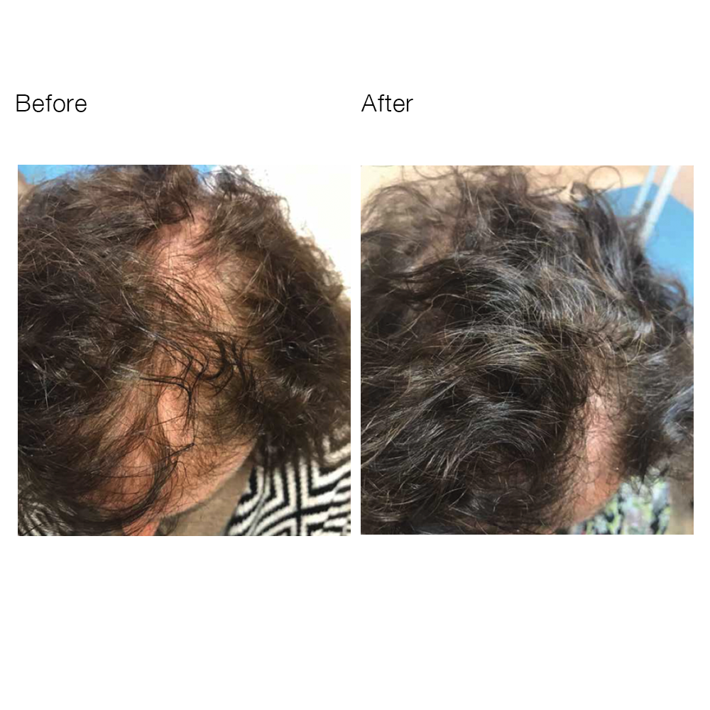 Hair filler-TrichotoKefalis2