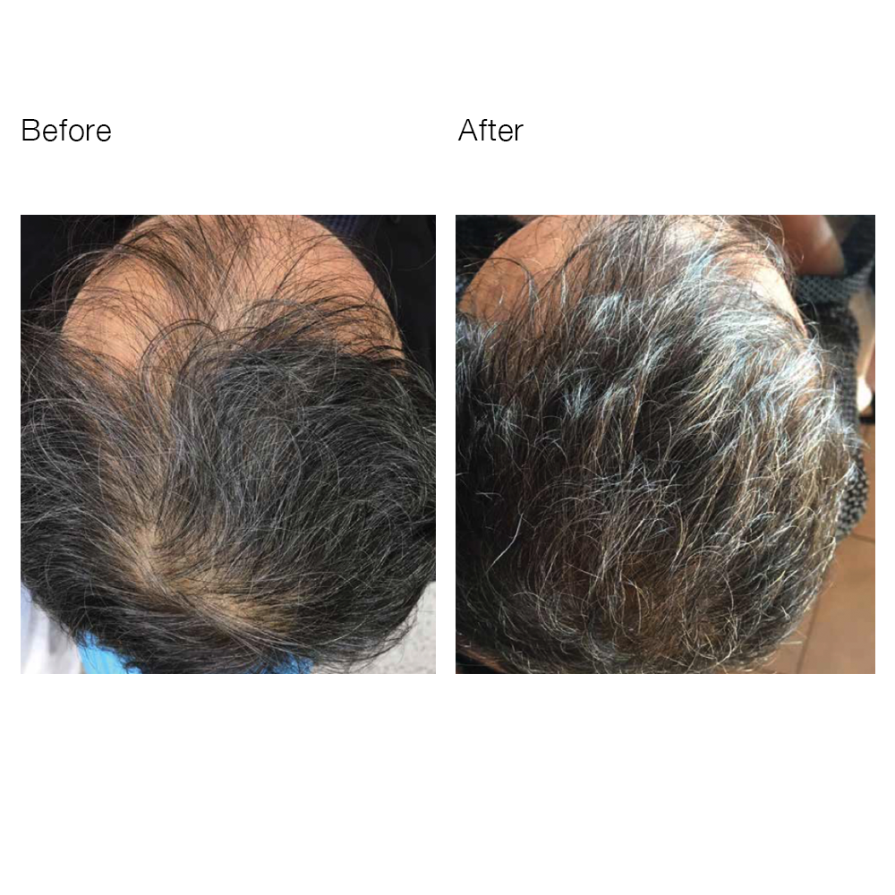 Hair filler-TrichotoKefalis3