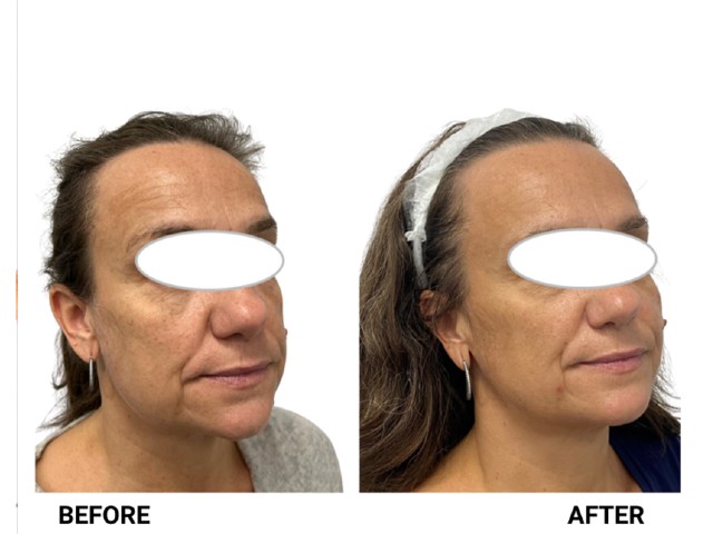 nucleoskin-topic-ba-4